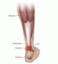 Achilles Tendon Tear