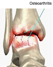 Ankle Arthritis