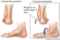 Excessive Pronation