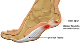 Plantar Fasciitis