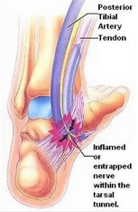 Tarsal Tunnel Syndrome