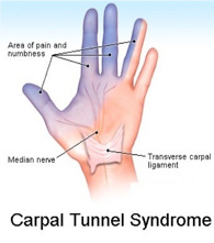 Carpal Tunnel Pain